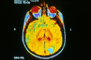 MRI Brain Scan.